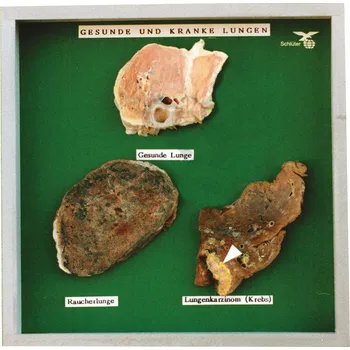 anatomický model Plíce kuřáka - model