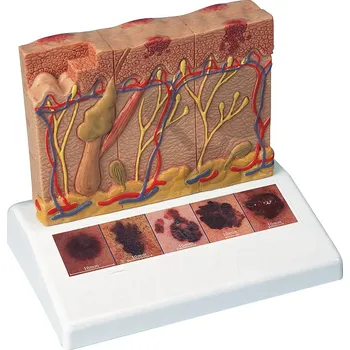 anatomický model Rakovina kůže - model