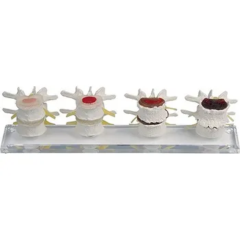 Erler-Zimmer Stadia degenerace meziobratlové ploténky