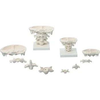 Erler-Zimmer Skloubení mezi lebkou a krčními obratli