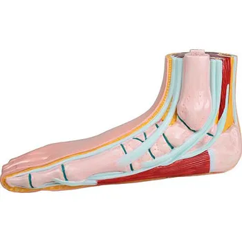 Erler-Zimmer Plochá noha, pes planus