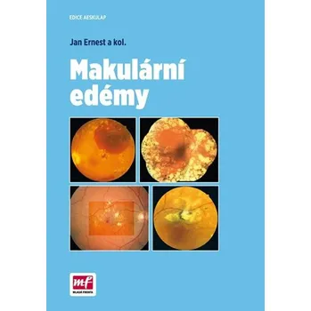 Makulární edémy - Jan Ernest a kolektiv