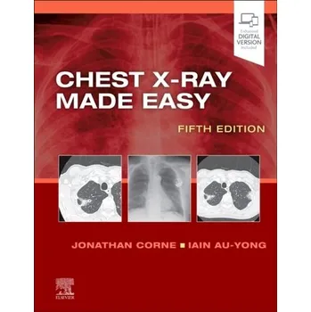 Chest X-Ray Made Easy - Jonathan Corne EN