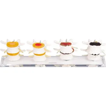 Erler Zimmer Fáze degenerativních změn meziobratlových plotének