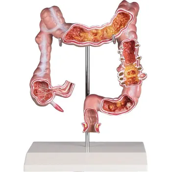 Tlusté střevo s onemocněním
