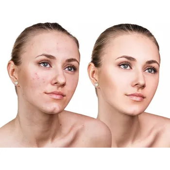 Léčba akné Proti akné