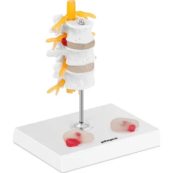 anatomický model Physa PHY-SM-6 model výhřezu meziobratlové ploténky