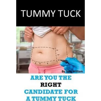 Tummy Tuck: Are You The Right Candidate For A Tummy Tuck - Tony William [EN] (2017, brožovaná)