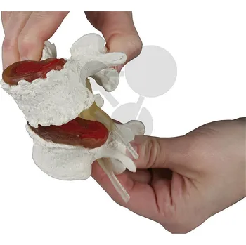 anatomický model Stadia poškození meziobratlových plotýnek