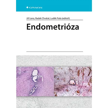 Endometrióza