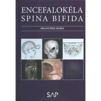 Encefalokéla spina bifida - Horn, František