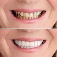 Deminas | Praktická dočasná snímatelná zubní náhrada