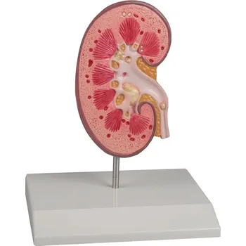 Ledvina s ledvinovým kamenem