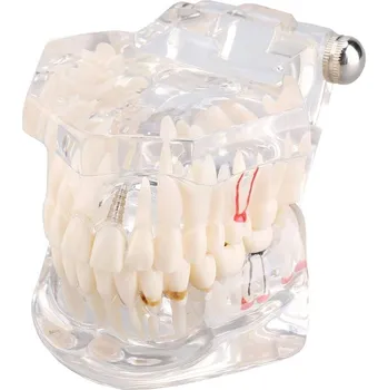 anatomický model Verk 01964-B model zubních implantátů bílý