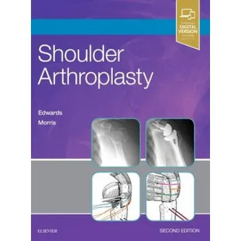 Shoulder Arthroplasty – T. Bradley Edwards (EN)