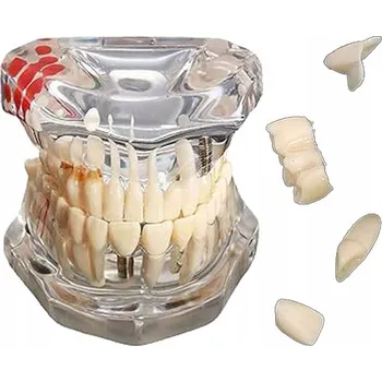 MODEL LIDSKÉ ČELISTI S CHRUPEM ZUBŮ ZUBNÍ IMPLANT ZUBY