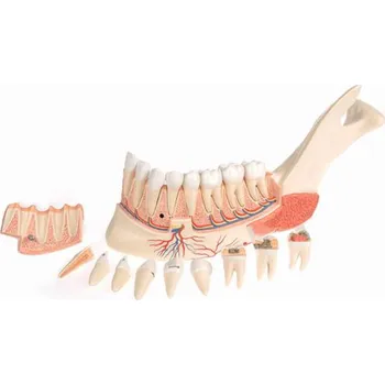 Pokročilá poloviční dolní čelist s 8 nemocnými zuby, 19 částí (Anatomické modely)