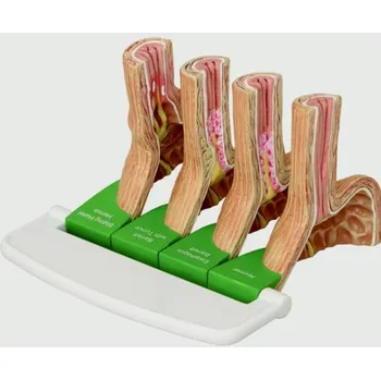 4-pc Gerd (gastroezofageální refluxní choroba) (Anatomické modely)