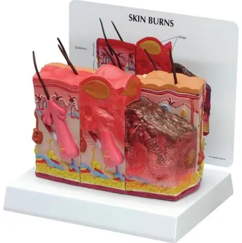 Série lidské pokožky s popáleninami, 75 krát životní velikost (Anatomické modely)
