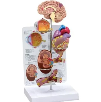 Sada na hypertenzi (Anatomické modely)