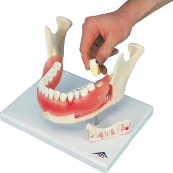 Zubní onemocnění, zvětšené 2 krát, 21 částí (Anatomické modely)