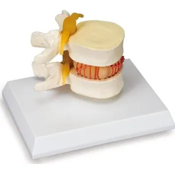 Simulátor herniovaného disku (Anatomické modely)