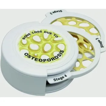 Sada kloubových disků - 4ks Osteoporóza (Anatomické modely)