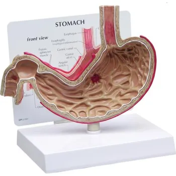 Model žaludku s vředy (Anatomické modely)