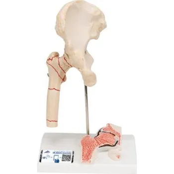Model zlomeniny lidské stehenní kosti a osteoartrózy kyčle (Anatomické modely)