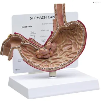 Model rakoviny žaludku (Anatomické modely)