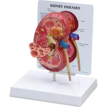 Model onemocnění ledvin (Anatomické modely)