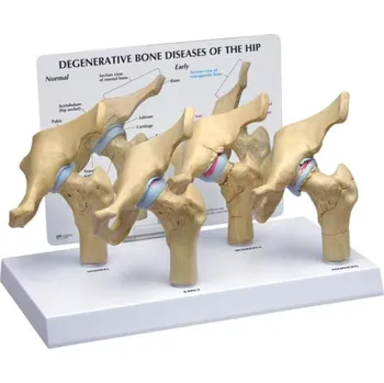 4-stupňové degenerativní kostní choroby modelu kyčle (Anatomické modely)