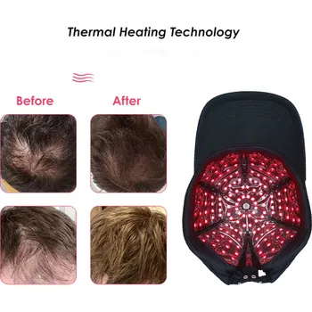 Vlasová regenerace Laserová helma na podporu rastu vlasov (Laserové přístroje)