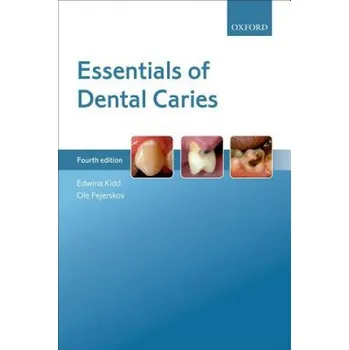 Essentials of Dental Caries (Edwina A. M. Kidd,Ole Fejerskov)(Brožovaná)
