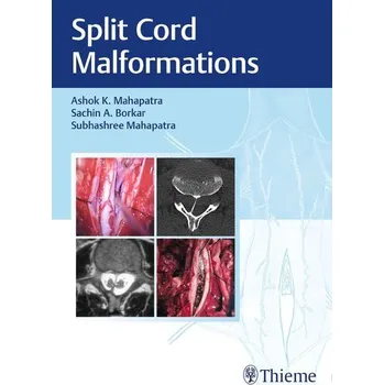 Split Cord Malformations - Mahapatra, Ashok Kumar