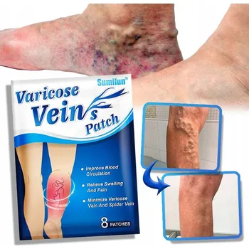 Náplast Náplasti na léčbu křečových žil, bolest nohou, otok a úleva