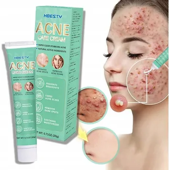 Léčba akné Krém proti akné účinný v léčbě akné a jizev po akné