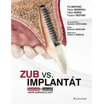 Zub vs. implantát: Zachovat, či nahradit vážně poškozený zub? Kniha