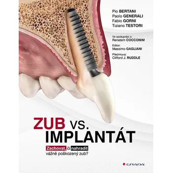 Zub vs. implantát - Zachovat, či nahradit vážně poškozený zub?