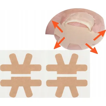 4 ks Náplasti korekční na Zarůstající nehty M