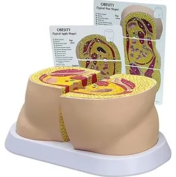 anatomický model Model Obezita