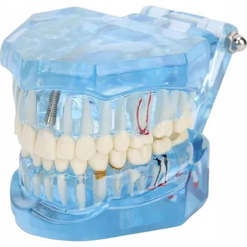 Elektrický zubní kartáček MODEL STOMATOLOGICKÝ ČELIST ZUBY ZUBNÍ IMPLANTÁTY