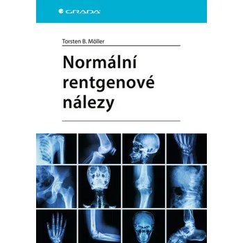 Normální rentgenové nálezy - Torsten B. Möller