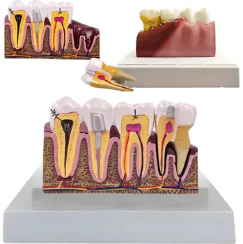 Zdraví VERK GROUP Anatomický stomatologický zubní model - vyjímatelný zub