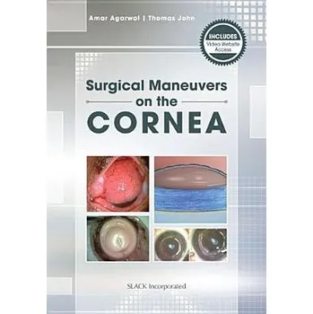 Mastering Corneal Surgery - Agarwal, Amar a John, Thomas