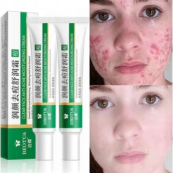 Léčba akné Krém na Akné Odstraňuje Skvrny po Akné Protizánětlivý v Tubě